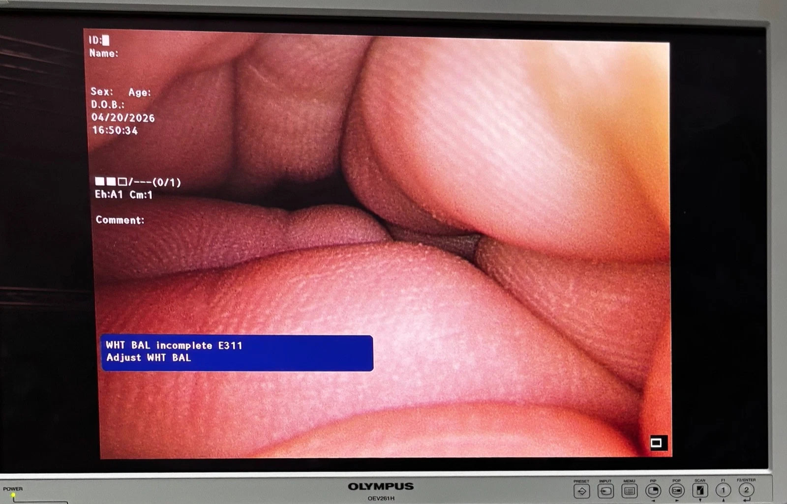 Olympus WA50040A 10.0 mm 0º HD ENDOEYE II Video Laparoscope